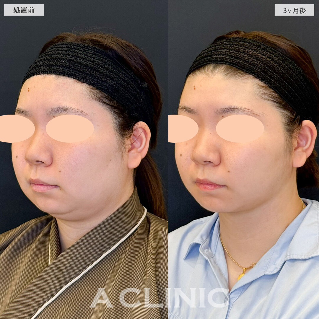 1day小顔脂肪吸引で気になっていた二重あご改善し小顔になりました！こちら処置前と3ヶ月後の症例です(20代女性)