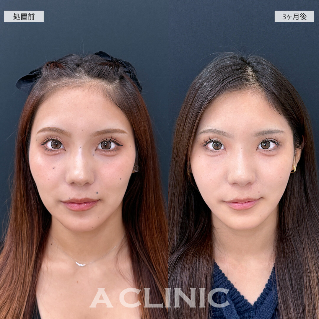 脂肪吸引で輪郭が整い垢抜けた印象になりました！1day小顔脂肪吸引の処置前と3ヵ月後の症例です(10代女性)
