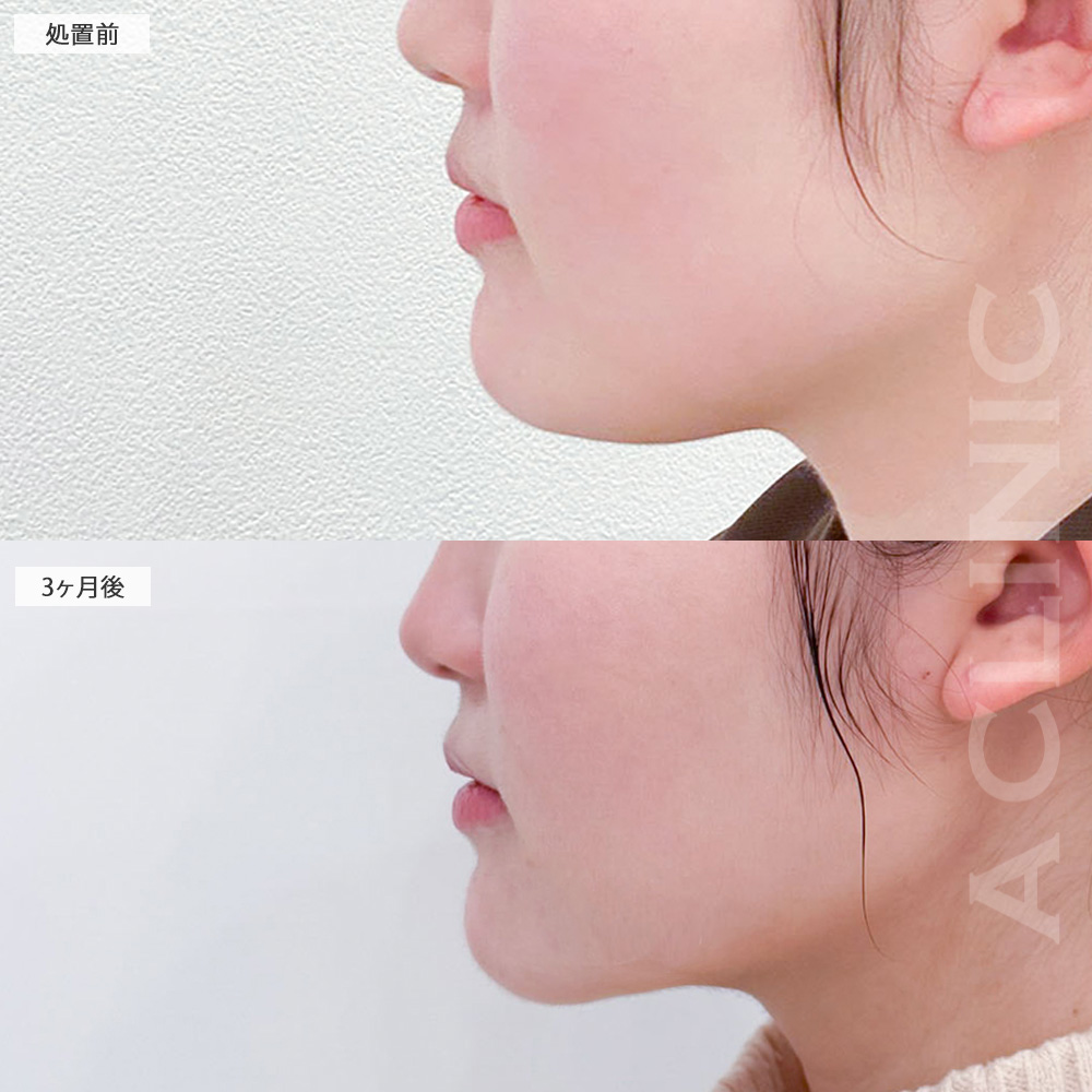 1day小顔脂肪吸引ならあご下のもたつきもここまでスッキリ！処置前から3ヶ月後の症例です(20代女性)