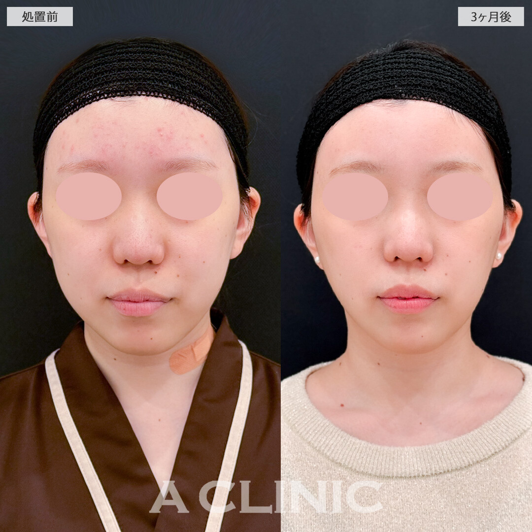 1day小顔脂肪吸引とバッカルファット除去術で輪郭の歪みを整えシャープなフェイスラインに！処置前と3ヶ月後の症例です(10代女性)