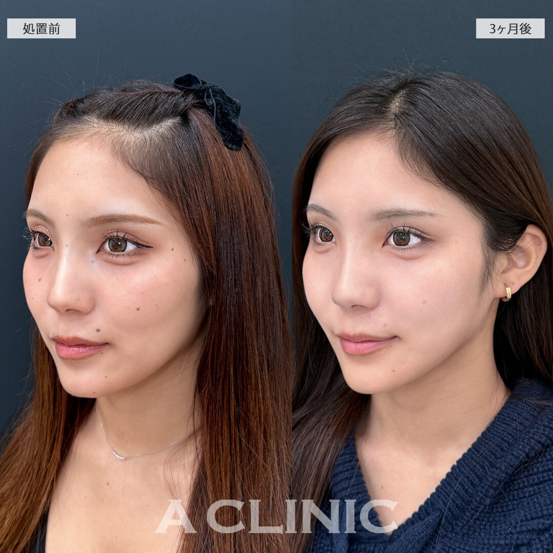脂肪吸引で輪郭が整い垢抜けた印象になりました！1day小顔脂肪吸引の処置前と3ヵ月後の症例です(10代女性)