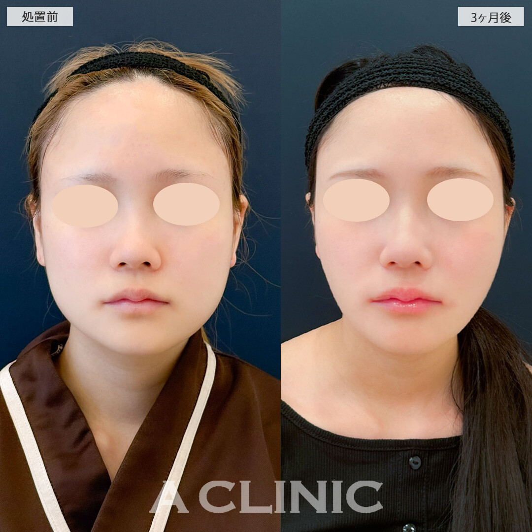 1day小顔脂肪吸引とバッカルファット除去術と小顔エラボトックスでしっかりVフェイスになりました！こちら処置前と3ヶ月後の症例です(20代女性)