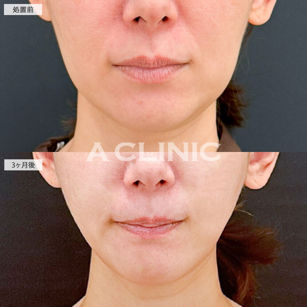 1day小顔脂肪吸引ならたるみ改善と脂肪減少で若返り！処置前から3ヶ月後の症例です(40代女性)