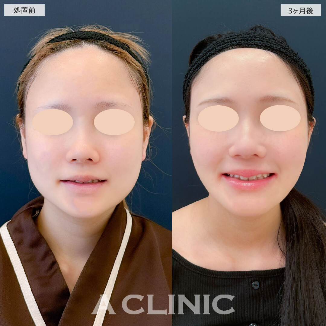 1day小顔脂肪吸引とバッカルファット除去術と小顔エラボトックスでしっかりVフェイスになりました！こちら処置前と3ヶ月後の症例です(20代女性)