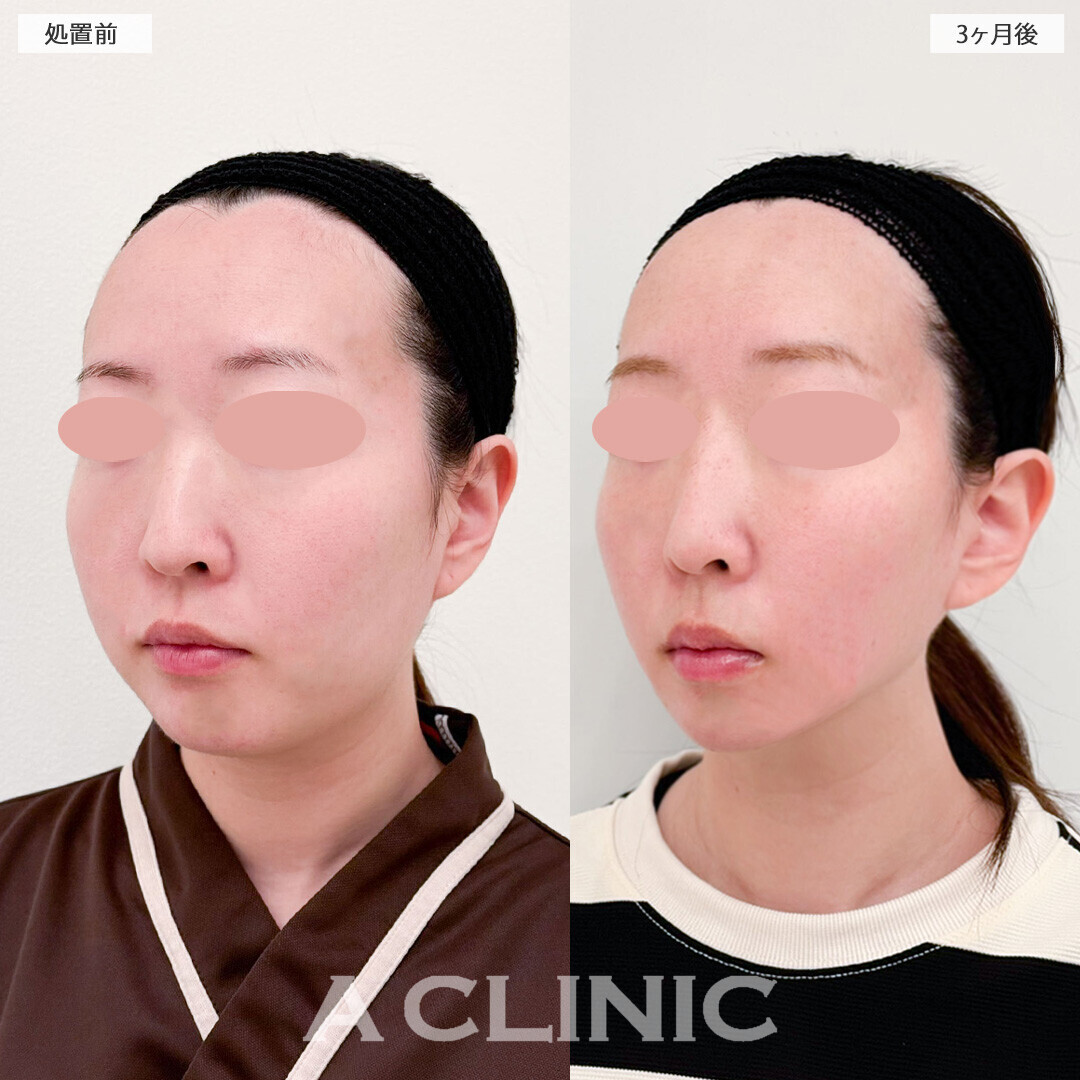 1day小顔脂肪吸引と小顔エラボトックスで理想通りの卵型フェイスに！処置前と3ヶ月後の症例です(20代女性)