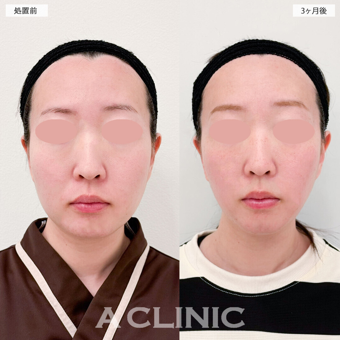 1day小顔脂肪吸引と小顔エラボトックスで理想通りの卵型フェイスに！処置前と3ヶ月後の症例です(20代女性)