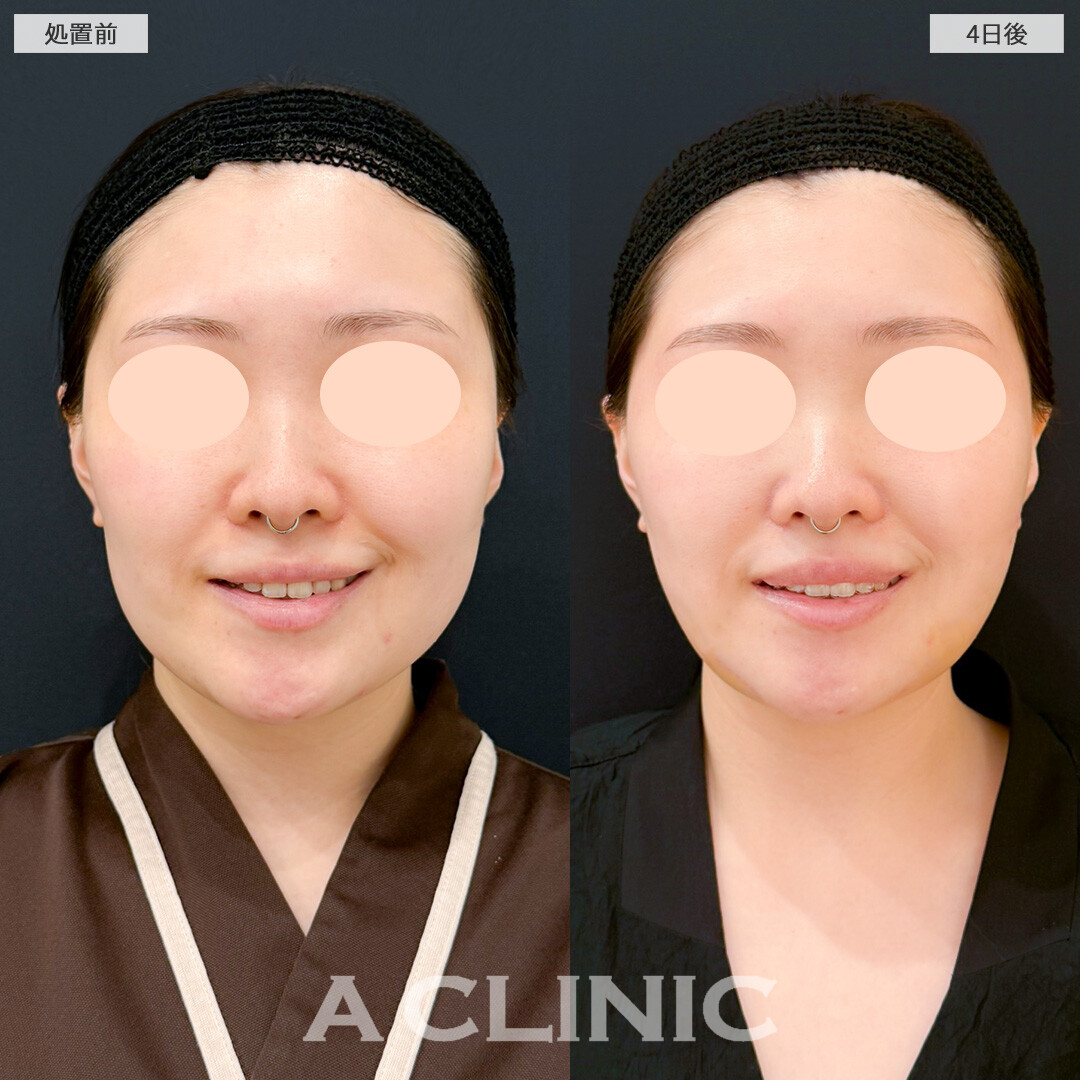 1day小顔脂肪吸引とバッカルファット除去術は術後数日でダウンタイムも気にならなくなりました！処置前と4日後の症例です(20代女性)