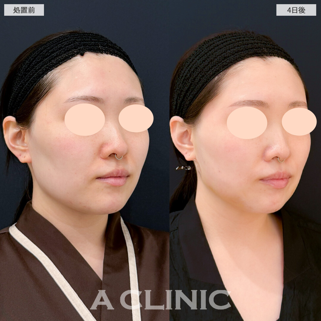 1day小顔脂肪吸引とバッカルファット除去術は術後数日でダウンタイムも気にならなくなりました！処置前と4日後の症例です(20代女性)