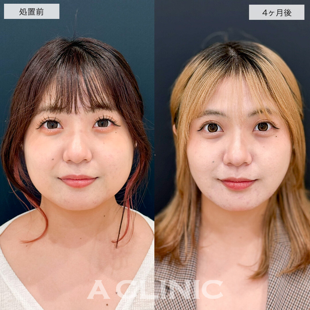 1day小顔脂肪吸引で二重顎改善し全方向美少女になりました!こちら処置前と4ヶ月後症例です(20代女性)