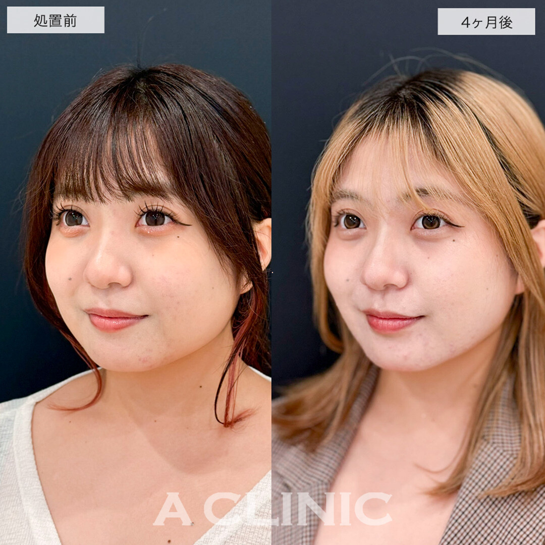 1day小顔脂肪吸引で二重顎改善し全方向美少女になりました!こちら処置前と4ヶ月後症例です(20代女性)