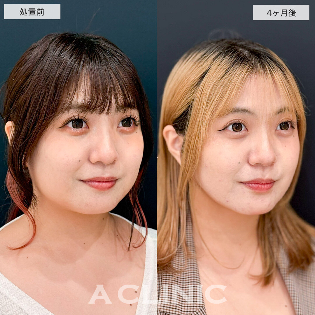 1day小顔脂肪吸引で二重顎改善し全方向美少女になりました!こちら処置前と4ヶ月後症例です(20代女性)