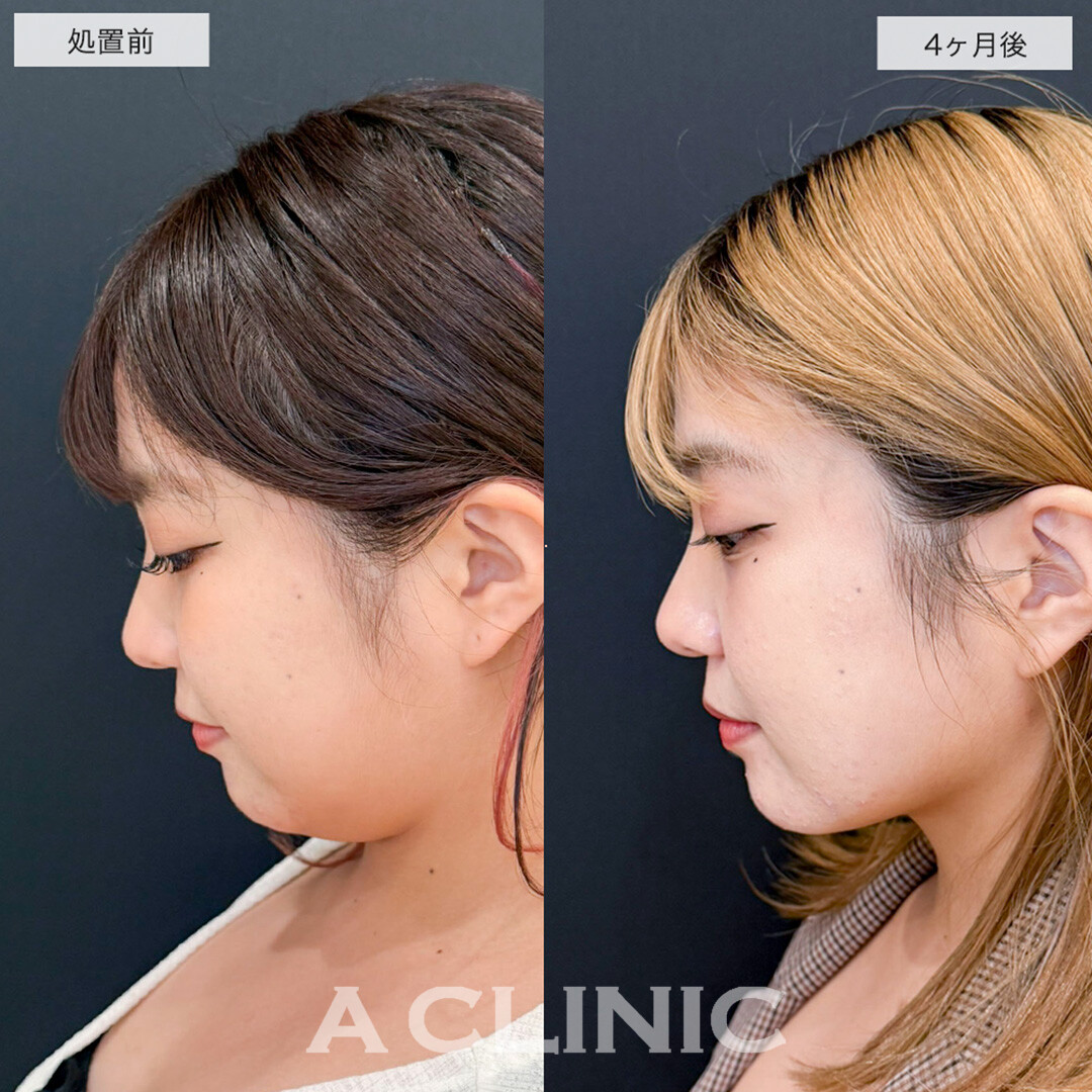 1day小顔脂肪吸引で二重顎改善し全方向美少女になりました!こちら処置前と4ヶ月後症例です(20代女性)