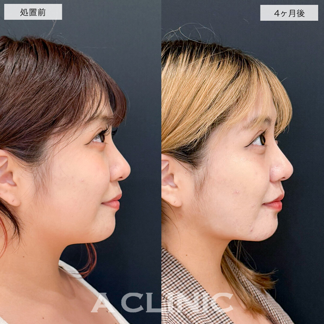 1day小顔脂肪吸引で二重顎改善し全方向美少女になりました!こちら処置前と4ヶ月後症例です(20代女性)