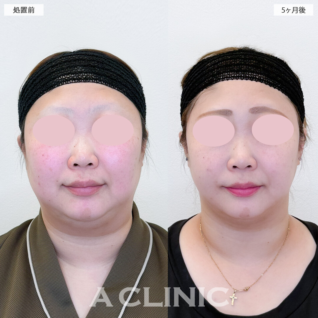 1day小顔脂肪吸引と小顔エラボトックスで首元とフェイスラインがすっきりスリムになりました！処置前と5ヶ月後の症例です(30代女性)