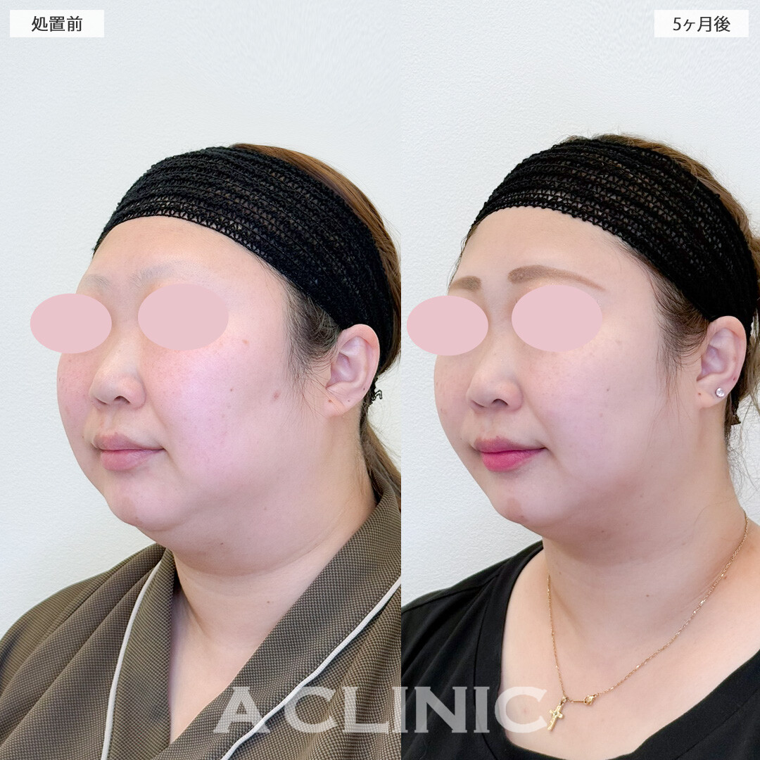 1day小顔脂肪吸引と小顔エラボトックスで首元とフェイスラインがすっきりスリムになりました！処置前と5ヶ月後の症例です(30代女性)