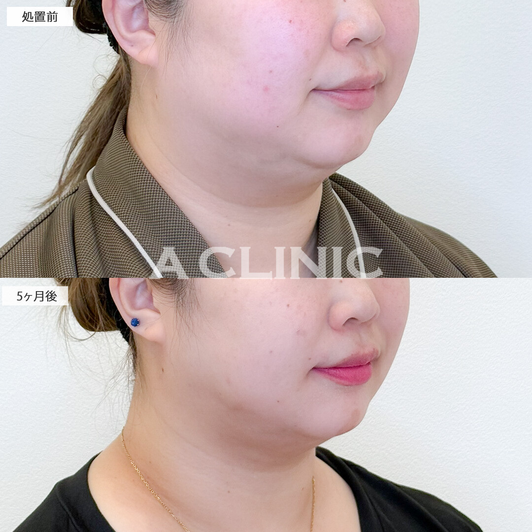 1day小顔脂肪吸引と小顔エラボトックスで首元とフェイスラインがすっきりスリムになりました！処置前と5ヶ月後の症例です(30代女性)