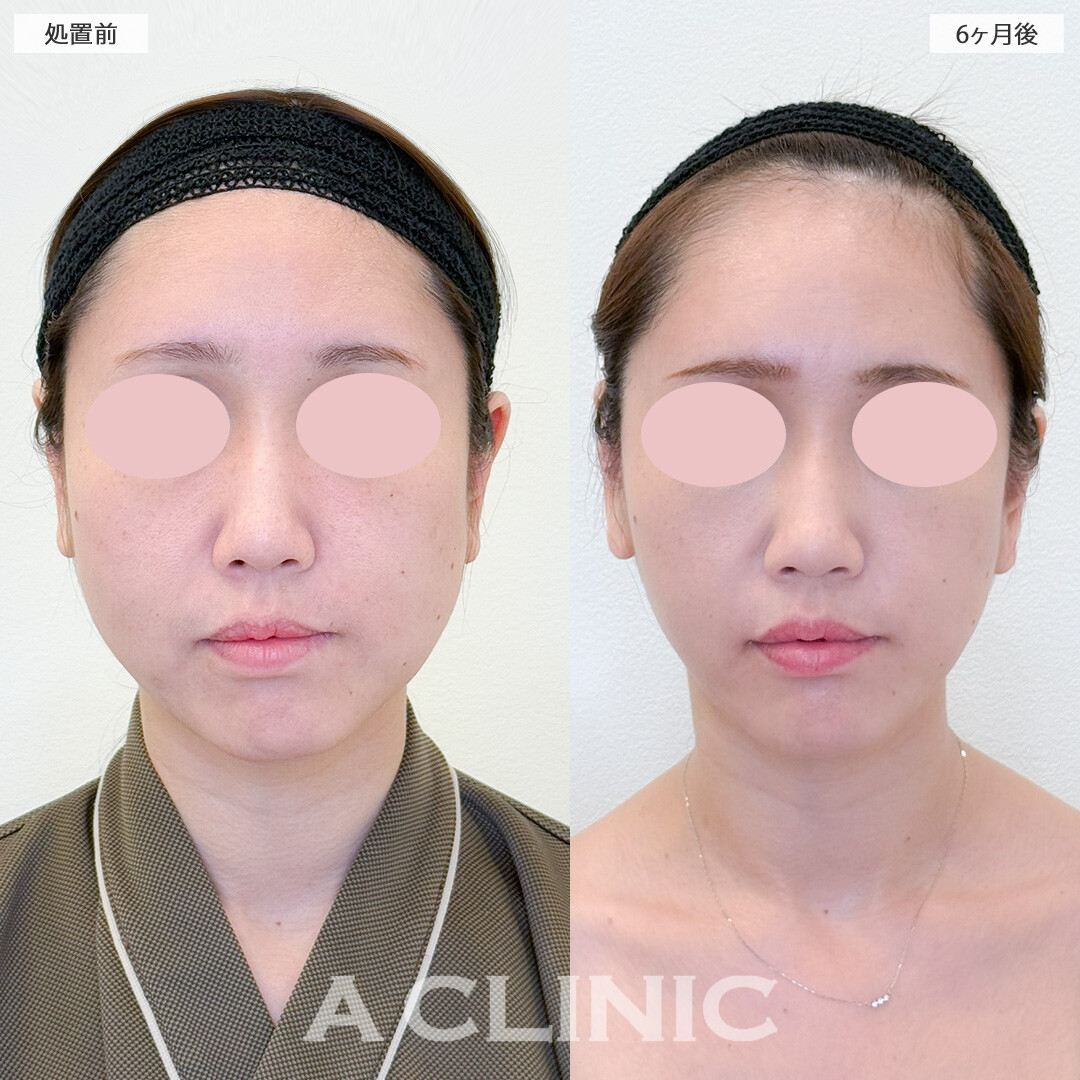 1day小顔脂肪吸引で半年経ってもこのスッキリ感を維持！処置前と6ヶ月後の症例です(30代女性)