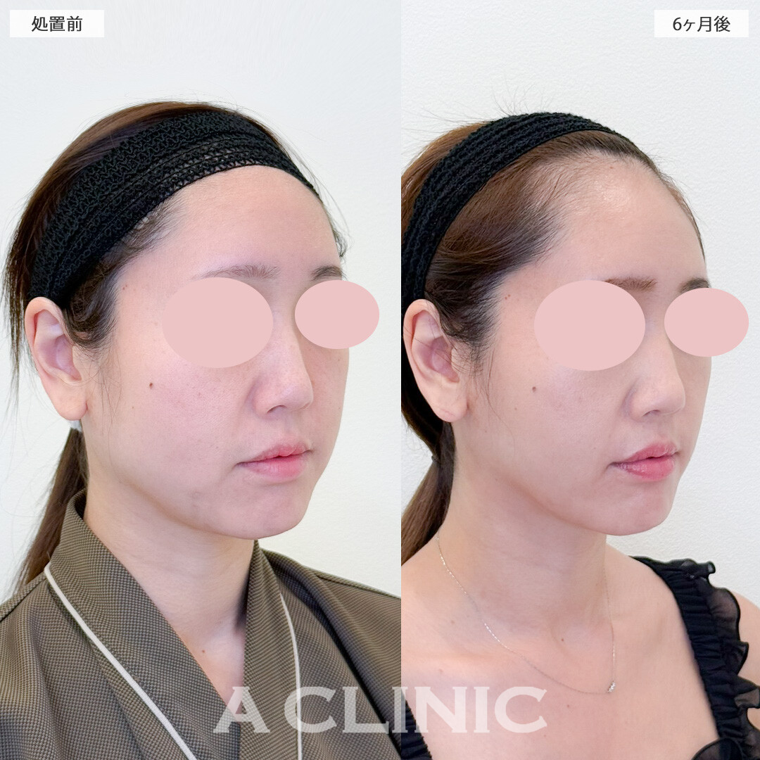 1day小顔脂肪吸引で半年経ってもこのスッキリ感を維持！処置前と6ヶ月後の症例です(30代女性)