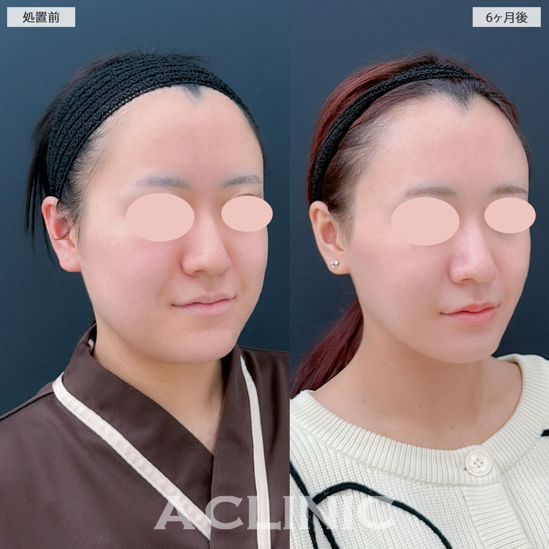 1day小顔脂肪吸引とバッカルファット除去術と小顔エラボトックスでスッキリ一回り小顔になりました！こちら処置前と6ヶ月後の症例です(20代女性)
