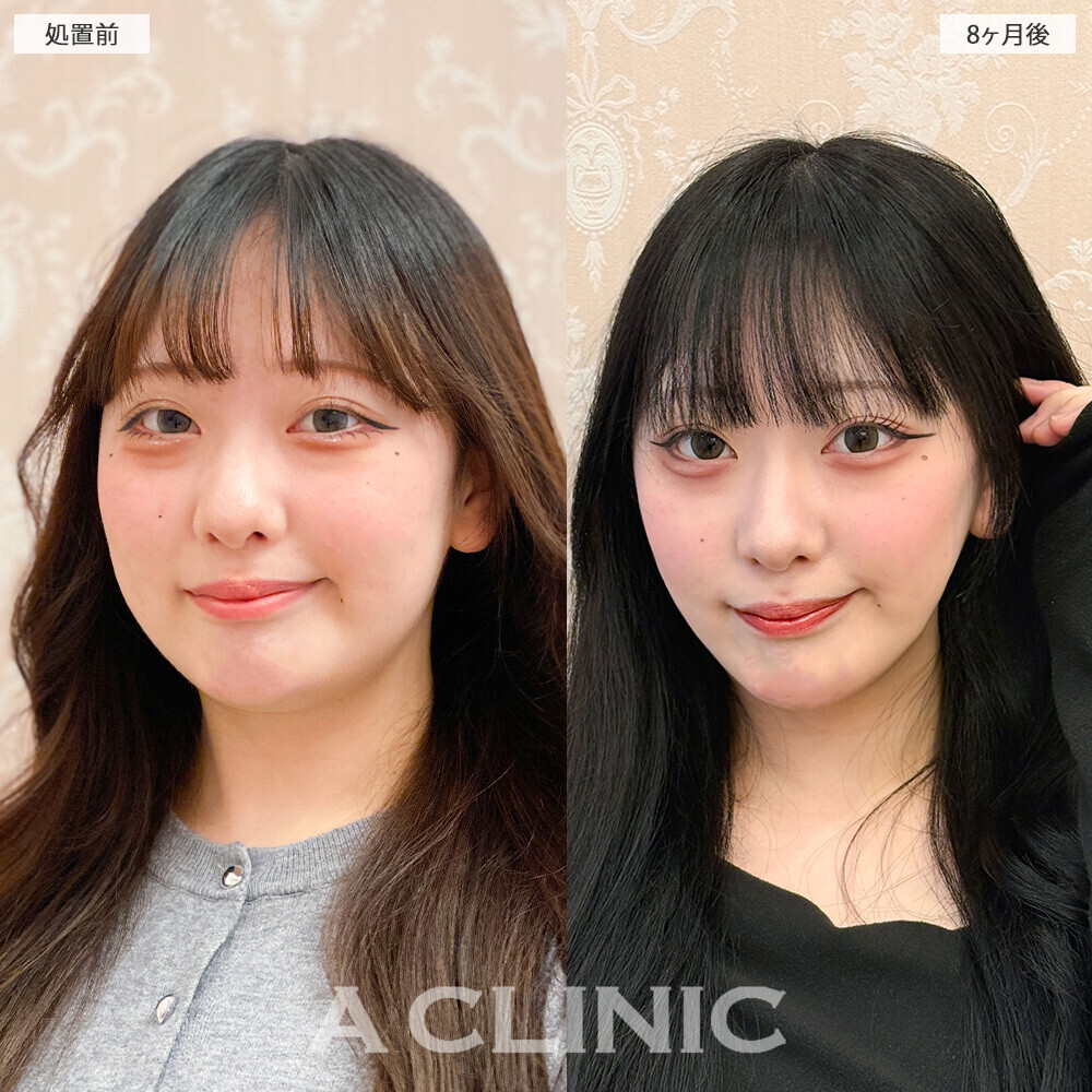 1day小顔脂肪吸引で時間が経ってもスッキリフェイス続く！こちら処置前から8ヶ月後の症例です(20代女性)