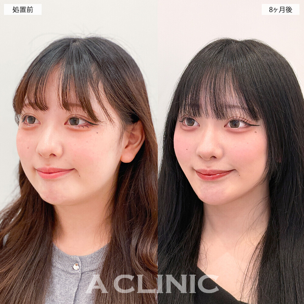 1day小顔脂肪吸引で時間が経ってもスッキリフェイス続く！こちら処置前から8ヶ月後の症例です(20代女性)