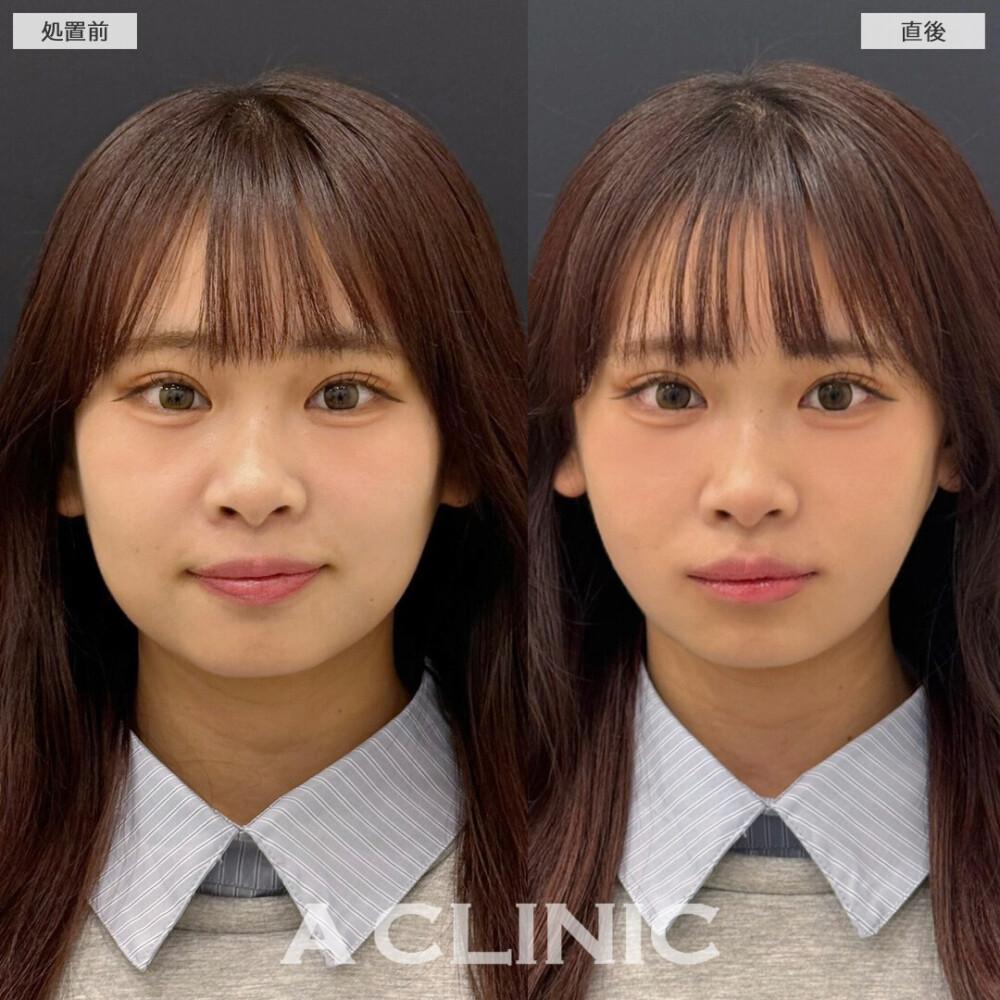 1day小顔脂肪吸引で直後から左右差改善し小顔になりました！こちら処置前と直後の症例です（20代女性）