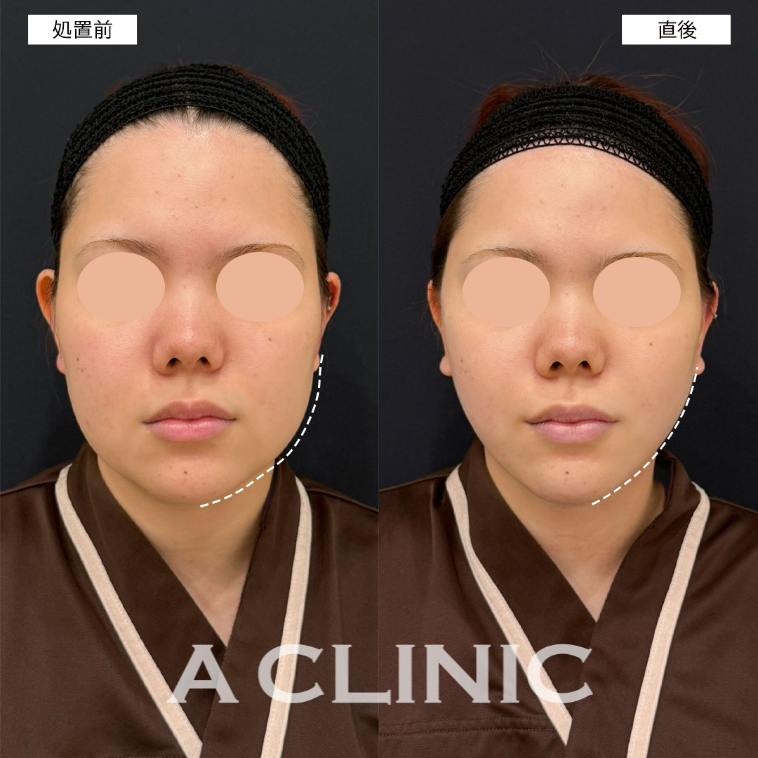 1day小顔脂肪吸引で直後からフェイスラインがシャープになりました！こちら処置前と直後の症例です(20代女性)