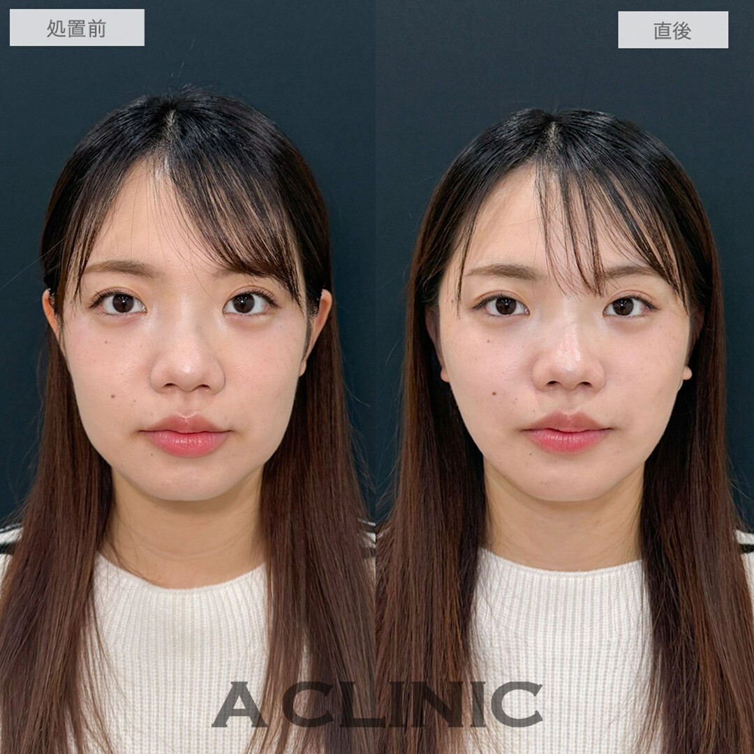 1day小顔脂肪吸引で下ぶくれの輪郭がきゅっと上向きに！こちら処置前と直後の症例です(20代女性)