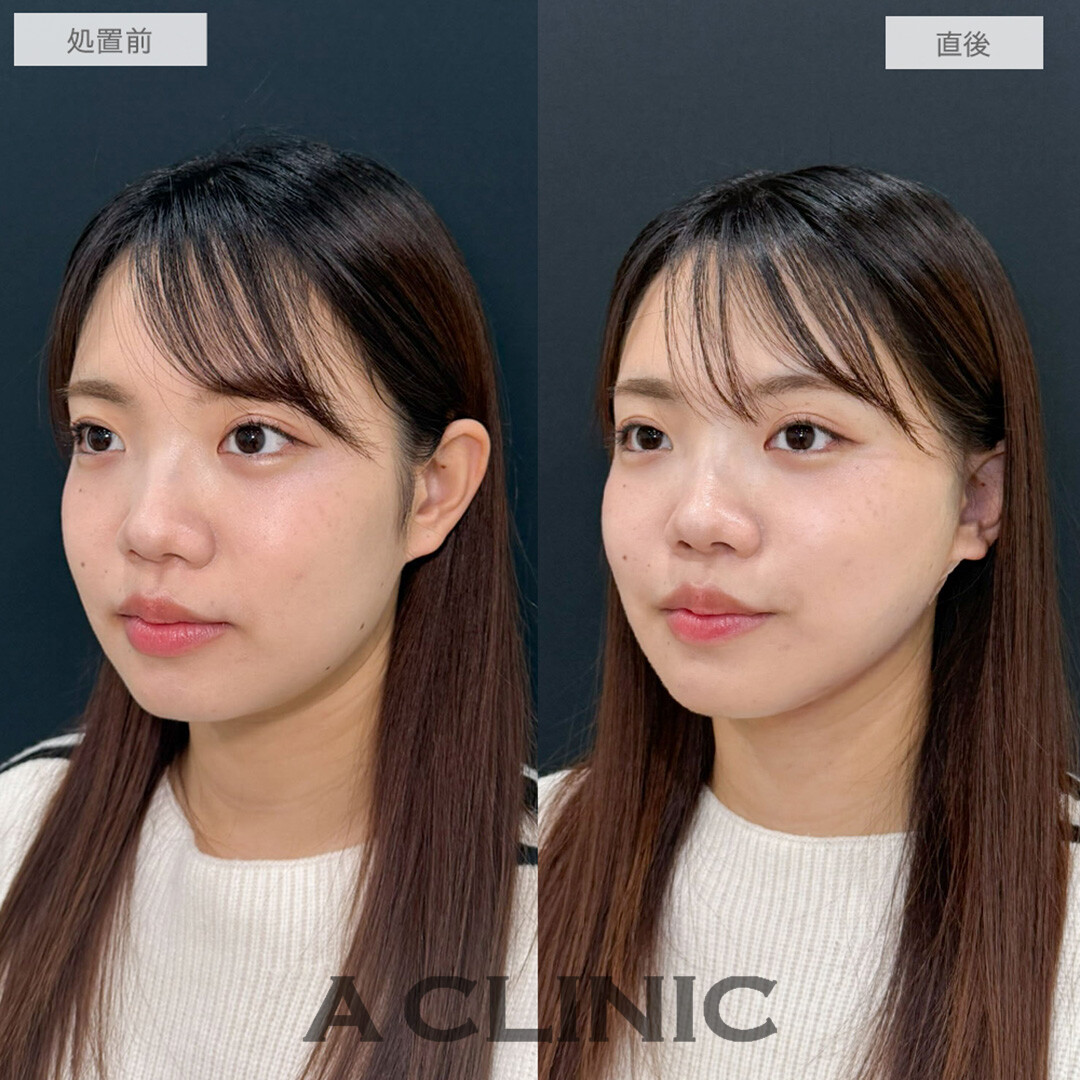 1day小顔脂肪吸引で下ぶくれの輪郭がきゅっと上向きに！こちら処置前と直後の症例です(20代女性)
