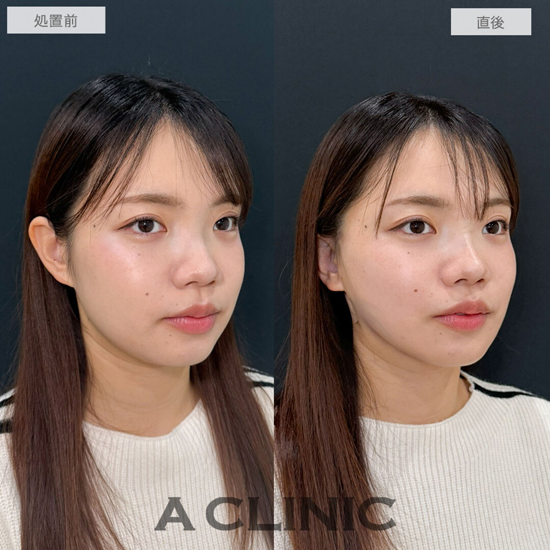 1day小顔脂肪吸引で下ぶくれの輪郭がきゅっと上向きに！こちら処置前と直後の症例です(20代女性)