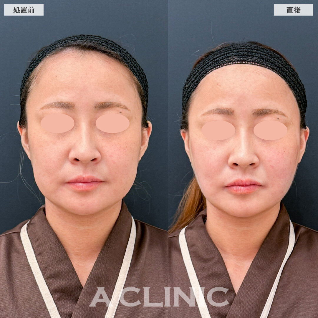 バッカルファット除去術の直後でこのダウンタイムの少なさです！こちら処置前と直後の症例です(30代女性)