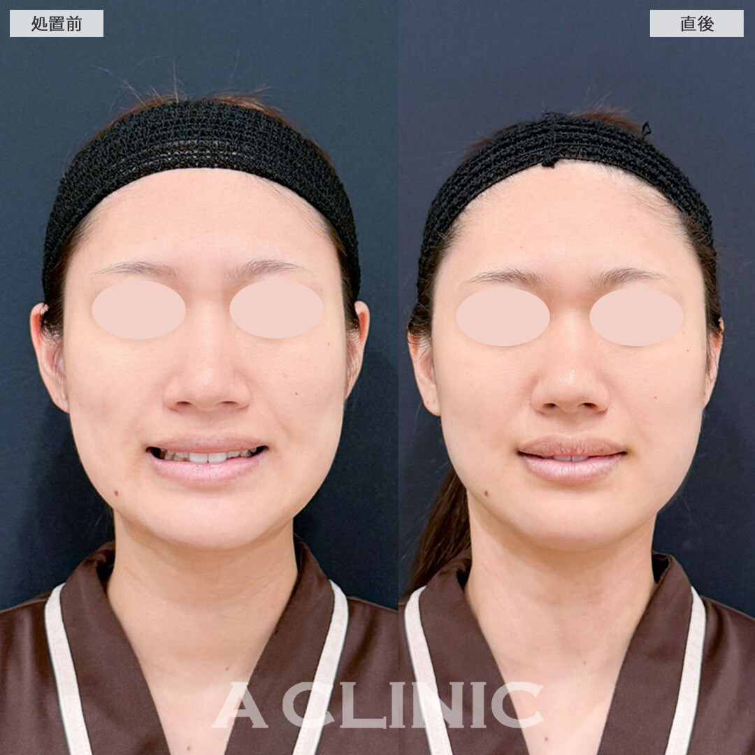 1day小顔脂肪吸引とバッカルファット除去術でフェイスラインのもたつきがなくなりました！こちら処置前と直後の症例です(20代女性)