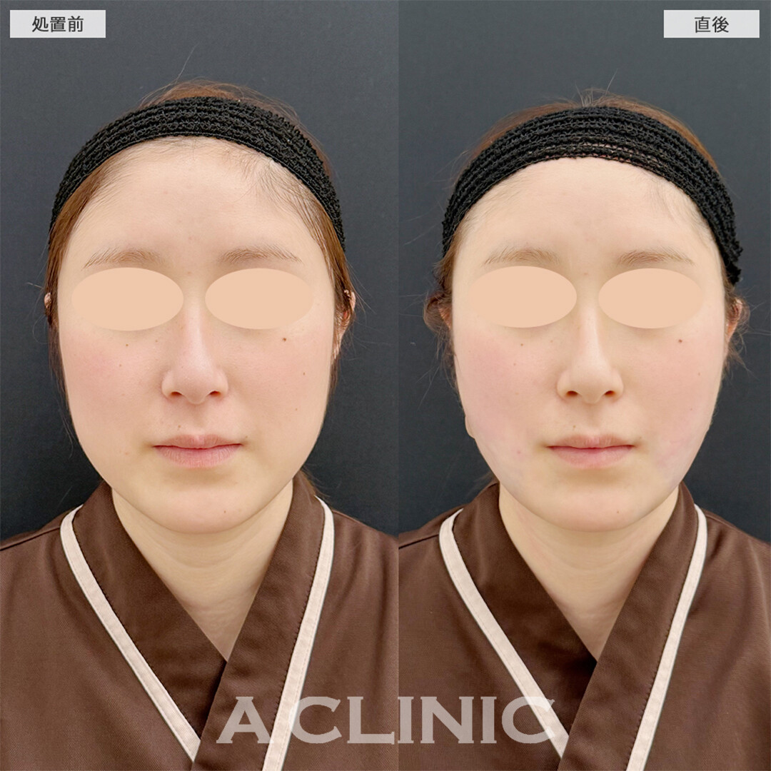 1day小顔脂肪吸引は直後から卵形輪郭になれます！こちら処置前と直後の症例です(20代女性)