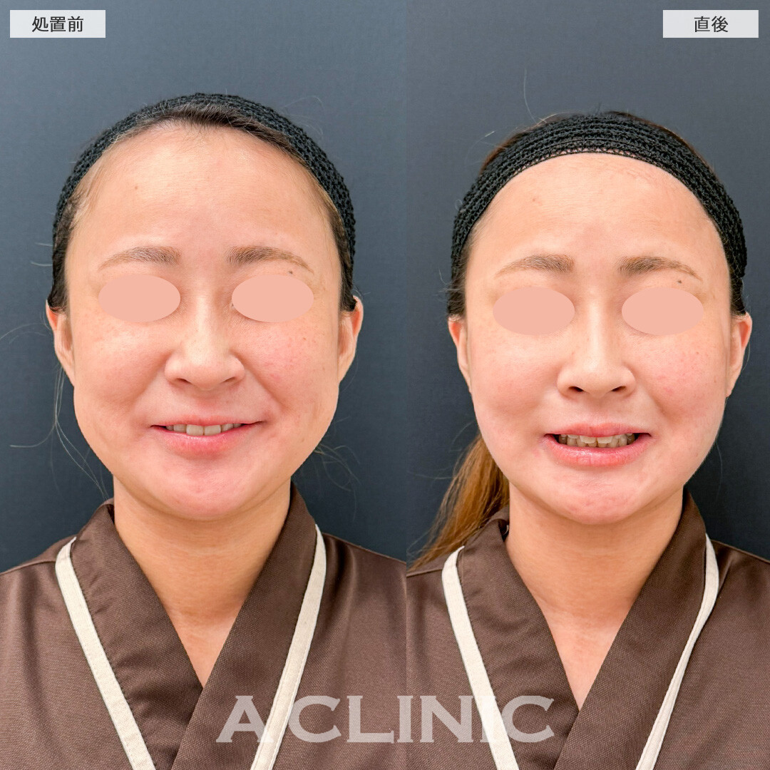 バッカルファット除去術の直後でこのダウンタイムの少なさです！こちら処置前と直後の症例です(30代女性)