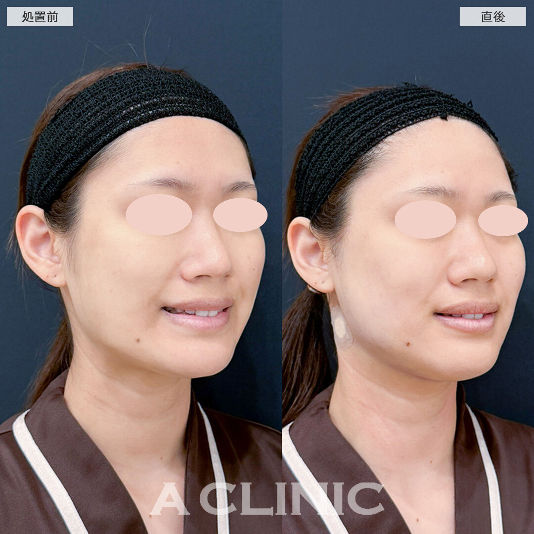 1day小顔脂肪吸引とバッカルファット除去術でフェイスラインのもたつきがなくなりました！こちら処置前と直後の症例です(20代女性)