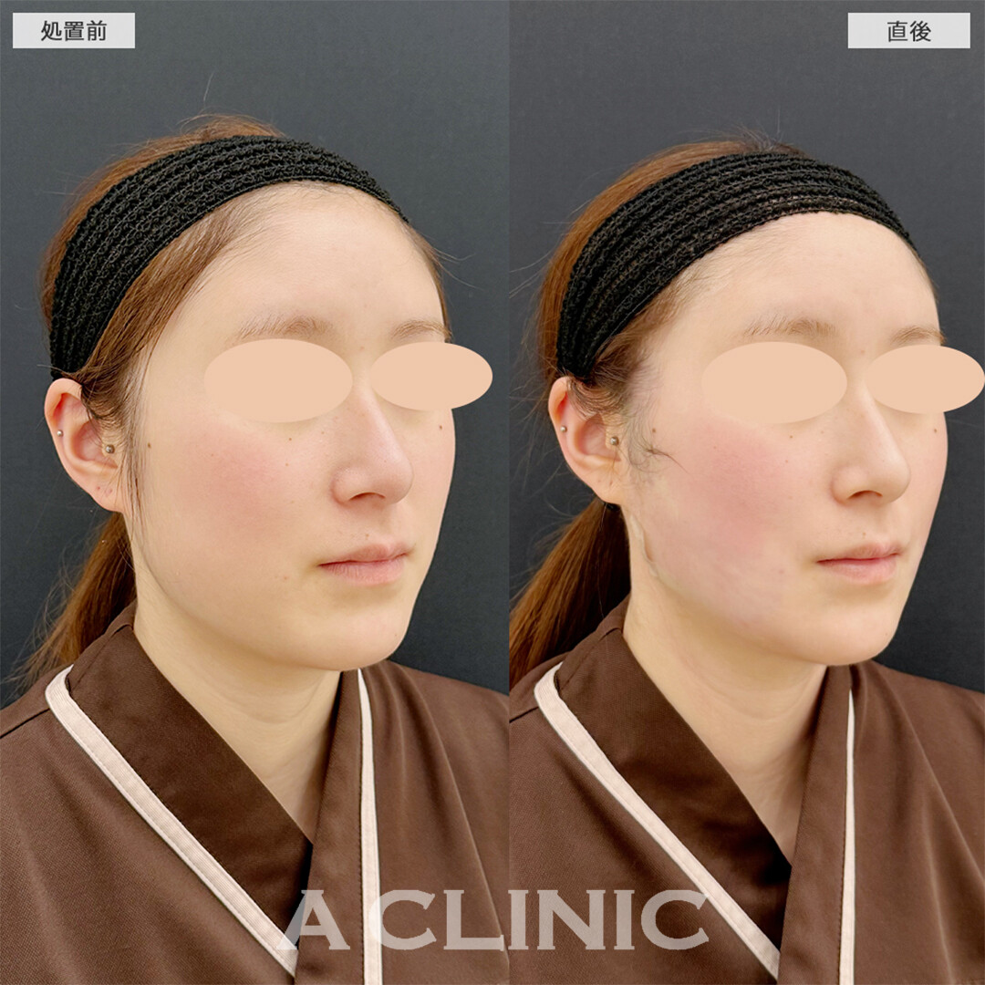 1day小顔脂肪吸引は直後から卵形輪郭になれます！こちら処置前と直後の症例です(20代女性)