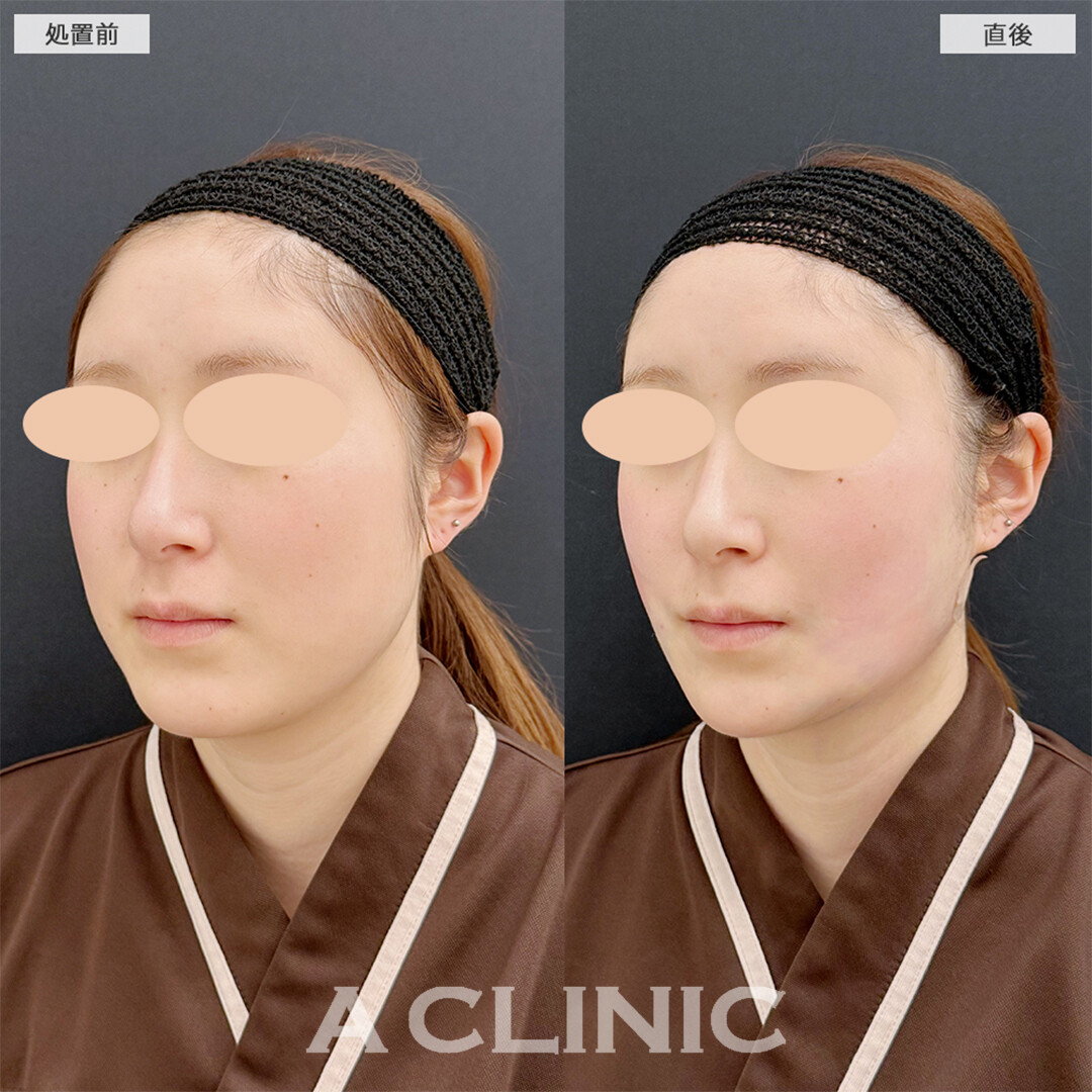 1day小顔脂肪吸引は直後から卵形輪郭になれます！こちら処置前と直後の症例です(20代女性)