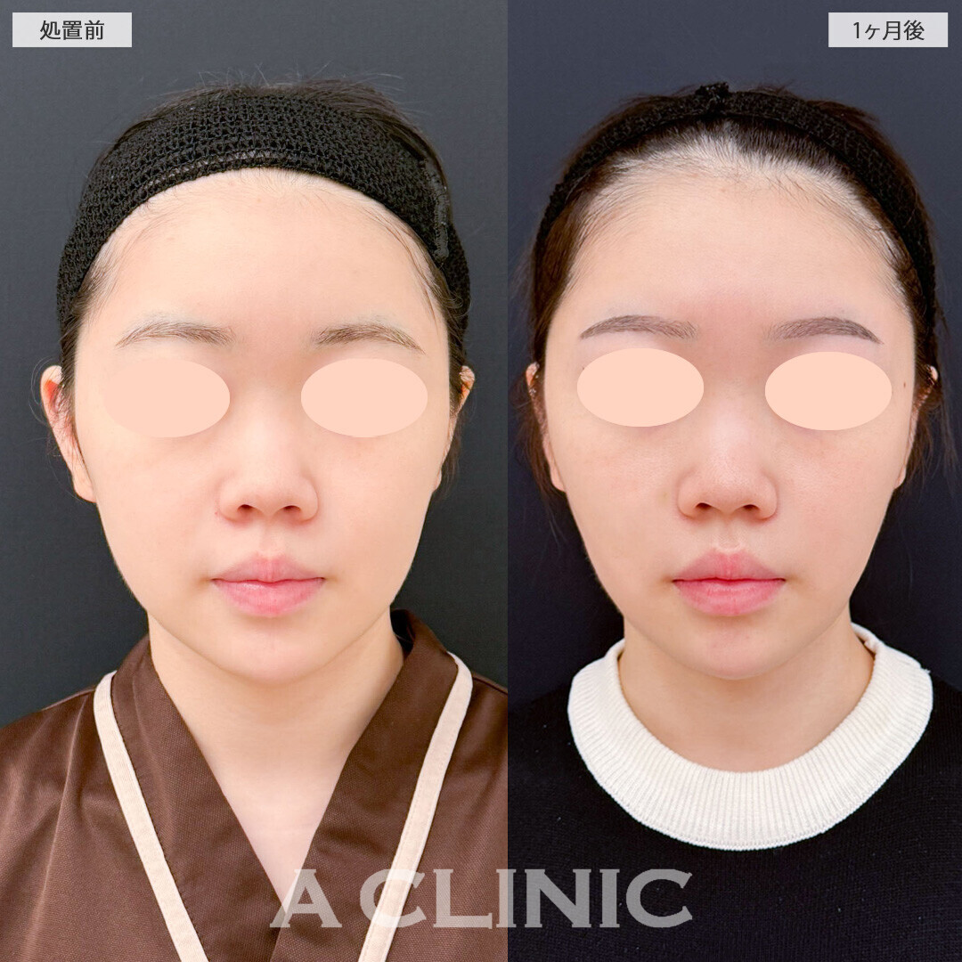 Aスレッドとバッカルファット除去術とナゾラビアルファット除去術で顔のボリューム感がグンと減りました！処置前から2ヶ月後の症例です(10代女性)