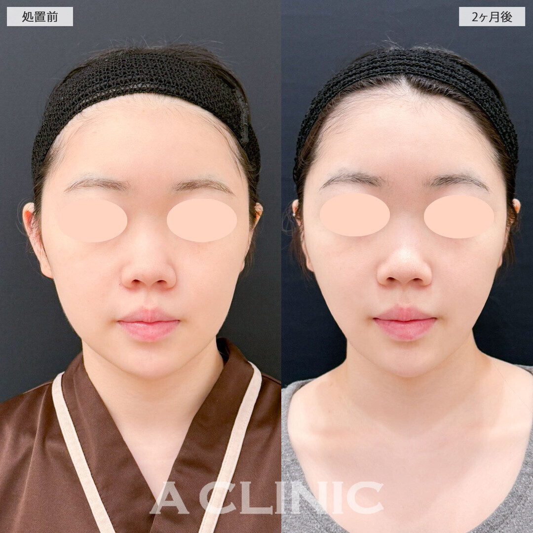 Aスレッドとバッカルファット除去術とナゾラビアルファット除去術で顔のボリューム感がグンと減りました！処置前から2ヶ月後の症例です(10代女性)