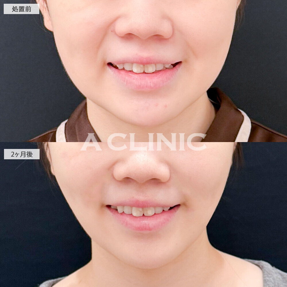 Aスレッドとバッカルファット除去術とナゾラビアルファット除去術で顔のボリューム感がグンと減りました！処置前から2ヶ月後の症例です(10代女性)