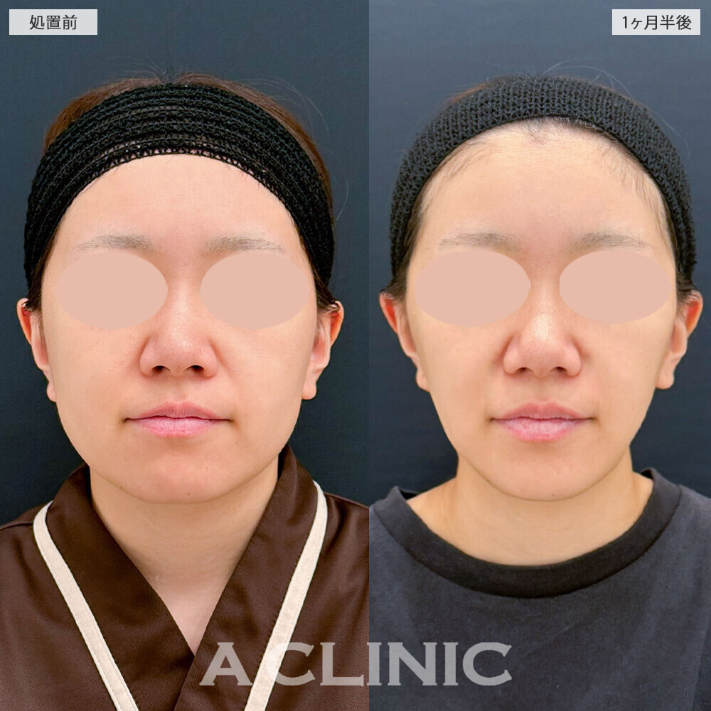 1day小顔脂肪吸引と小顔エラボトックスを合わせることでより小顔に！こちら処置前から1ヶ月半後の症例です(20代女性)
