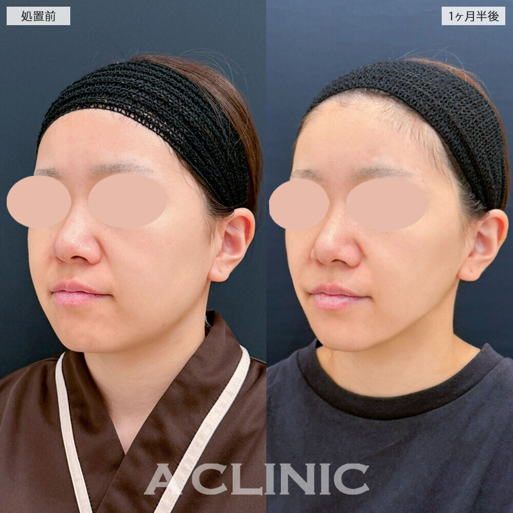 1day小顔脂肪吸引と小顔エラボトックスを合わせることでより小顔に！こちら処置前から1ヶ月半後の症例です(20代女性)