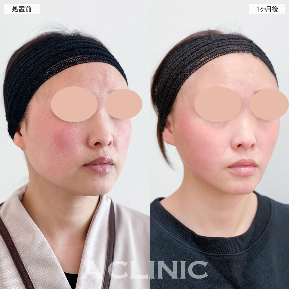 1day小顔脂肪吸引と小顔エラボトックスで顔の余白がなくなりスッキリしました！こちら処置前と1ヶ月後の症例です(30代女性)