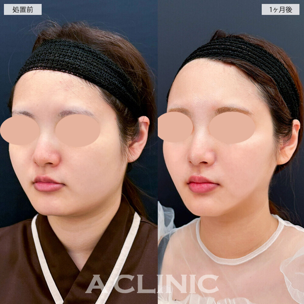 1day小顔脂肪吸引と小顔エラボトックスで四角く見える輪郭が改善！こちら処置前から2ヶ月半後の症例です(20代女性)