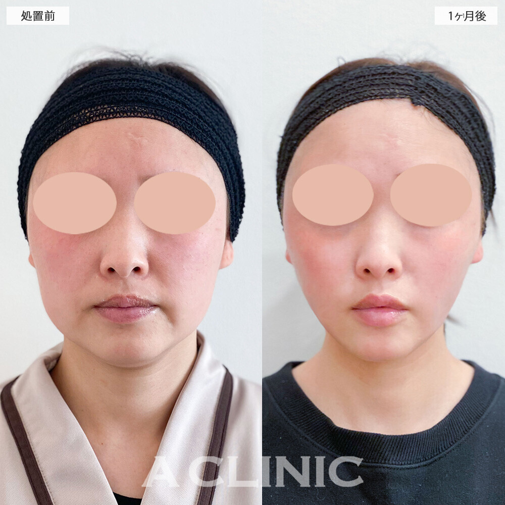 1day小顔脂肪吸引と小顔エラボトックスで顔の余白がなくなりスッキリしました！こちら処置前と1ヶ月後の症例です(30代女性)