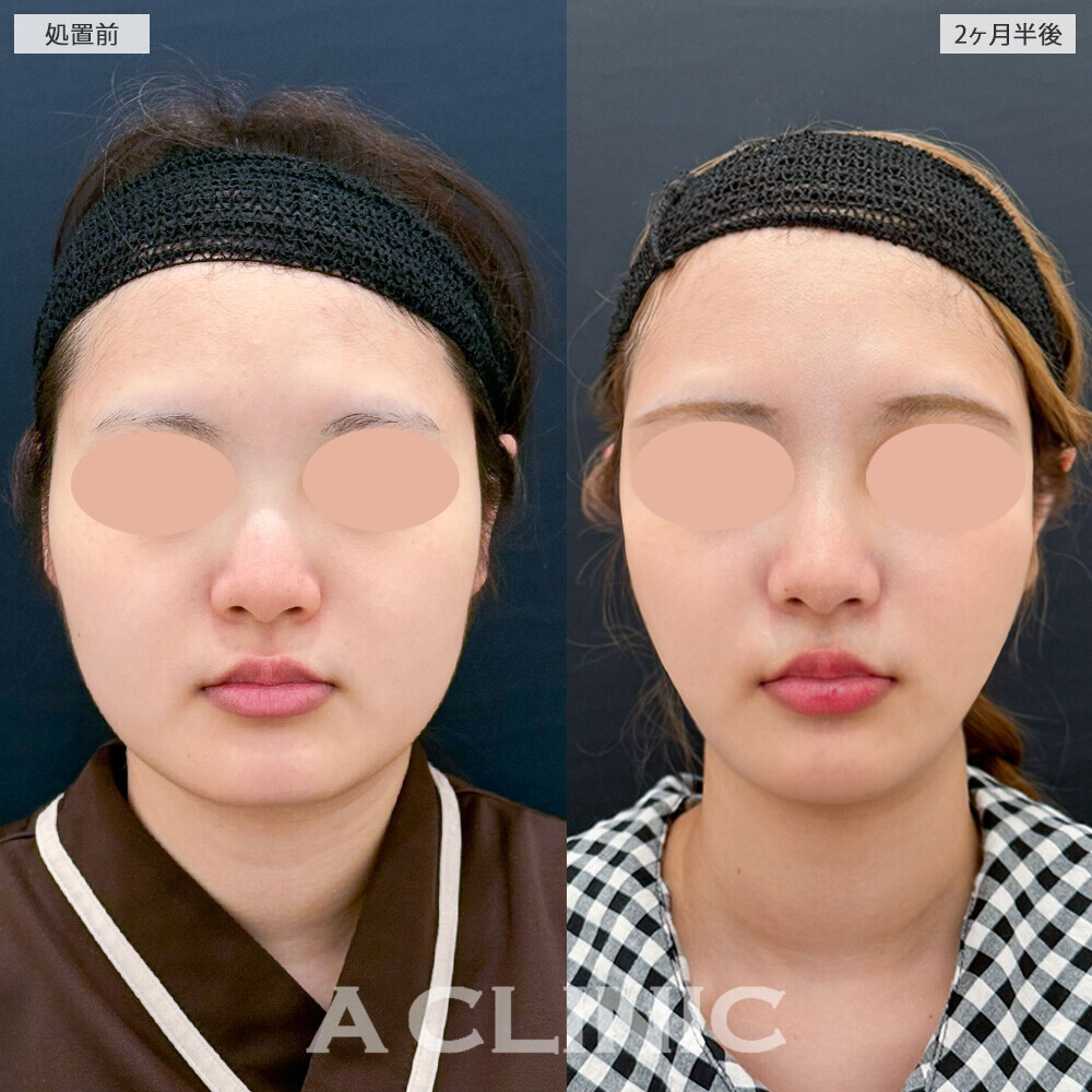 1day小顔脂肪吸引と小顔エラボトックスで四角く見える輪郭が改善！こちら処置前から2ヶ月半後の症例です(20代女性)