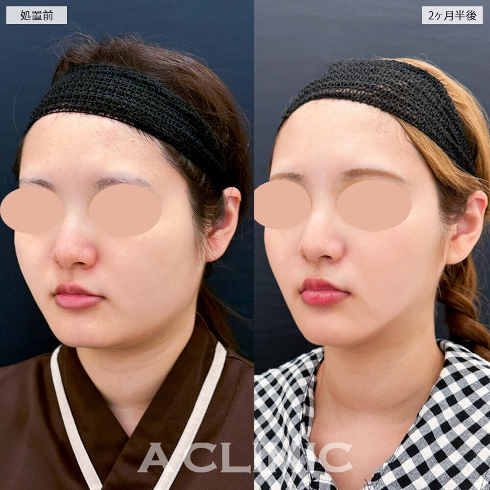 1day小顔脂肪吸引と小顔エラボトックスで四角く見える輪郭が改善！こちら処置前から2ヶ月半後の症例です(20代女性)