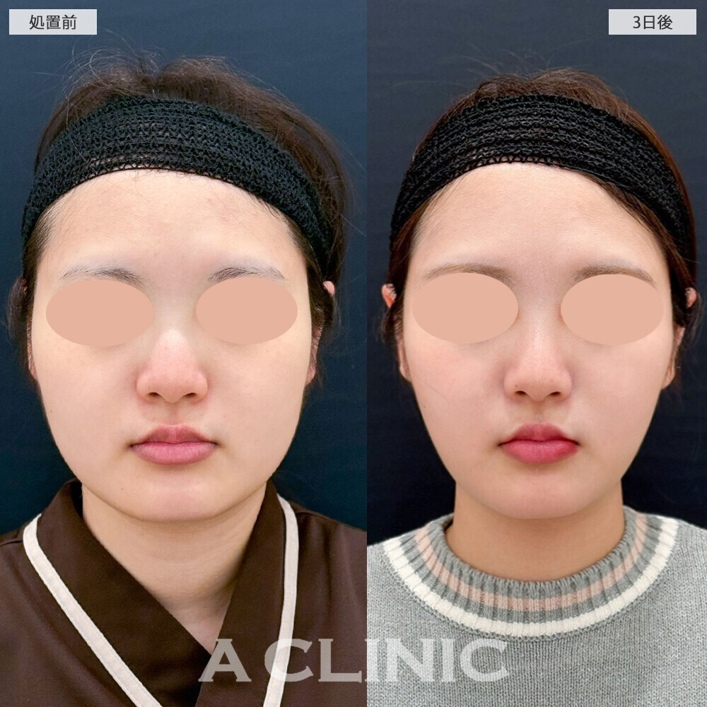 1day小顔脂肪吸引と小顔エラボトックスで四角く見える輪郭が改善！こちら処置前から2ヶ月半後の症例です(20代女性)