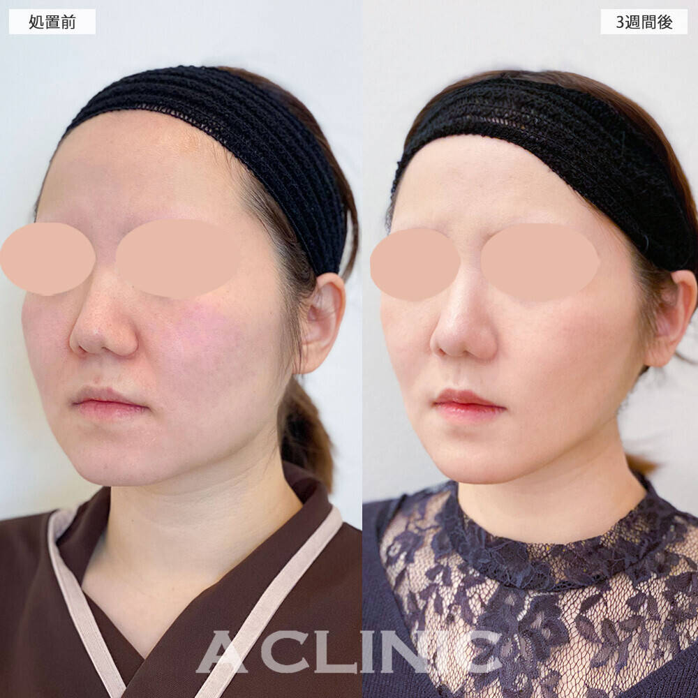 1day小顔脂肪吸引と小顔エラボトックスで卵型からVフェイスに！こちら処置前から3週間後の症例です(30代女性)