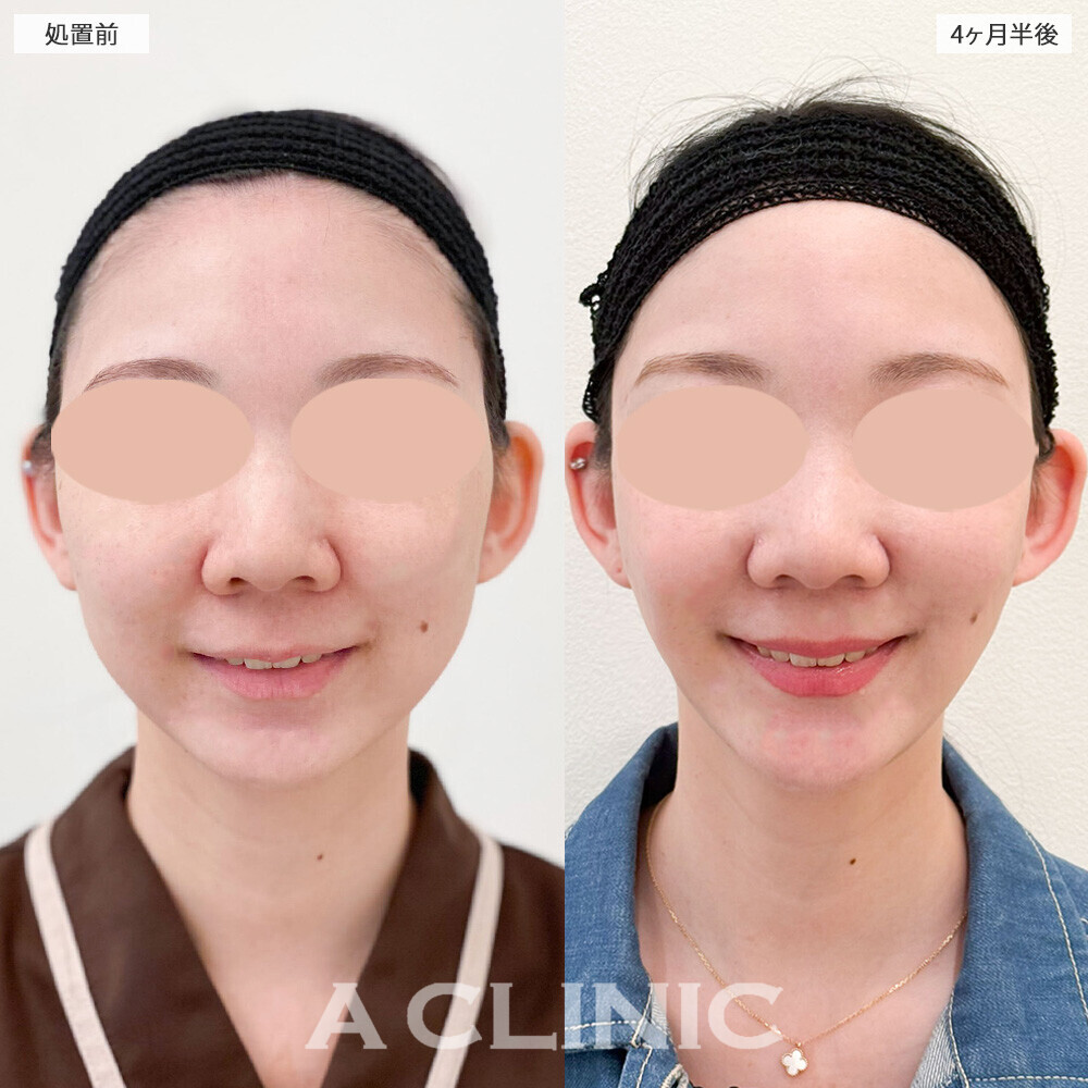 1day小顔脂肪吸引と小顔エラボトックスで余白のない卵型の輪郭に！こちら処置前から4ヶ月半後の症例です(30代女性)